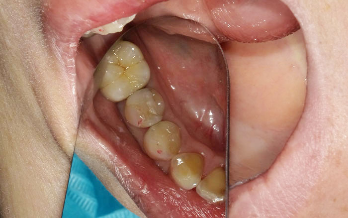 歯石とり時に虫歯を発見 新名主歯科 口腔外科医院